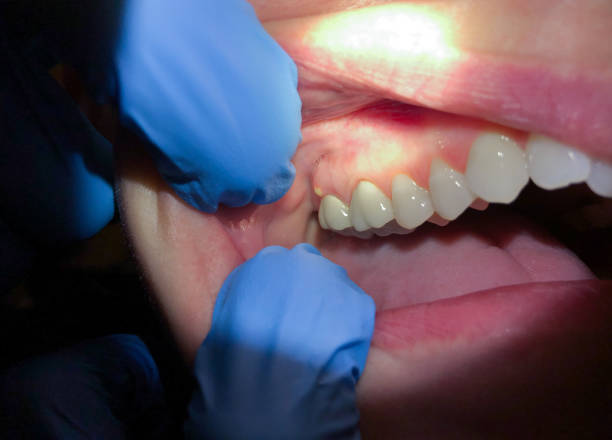 Best Emergency Cosmetic Dentistry (e.g., broken veneers) in Blue Ash, OH