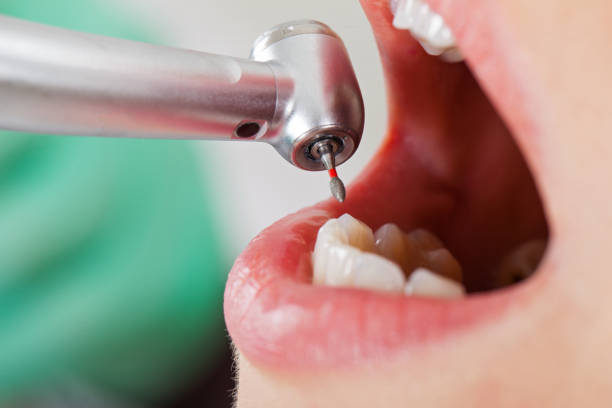 Best Lost Filling or Crown Replacement in Blue Ash, OH